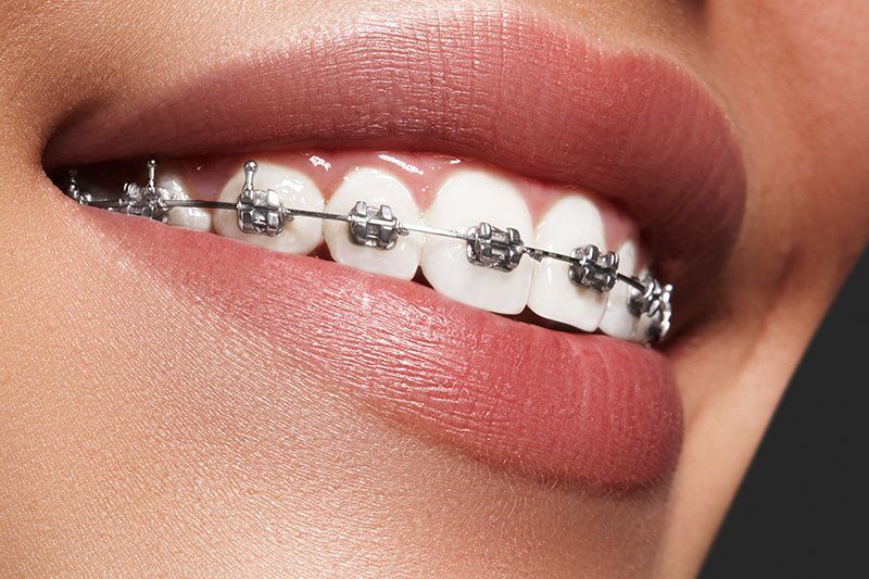Learn More About Orthodontics newly installed braces
