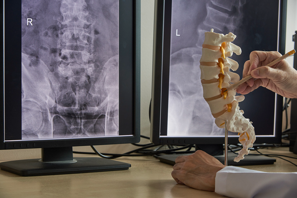Doctor pointing at spine model while viewing x-rays of a lower back on monitors.
