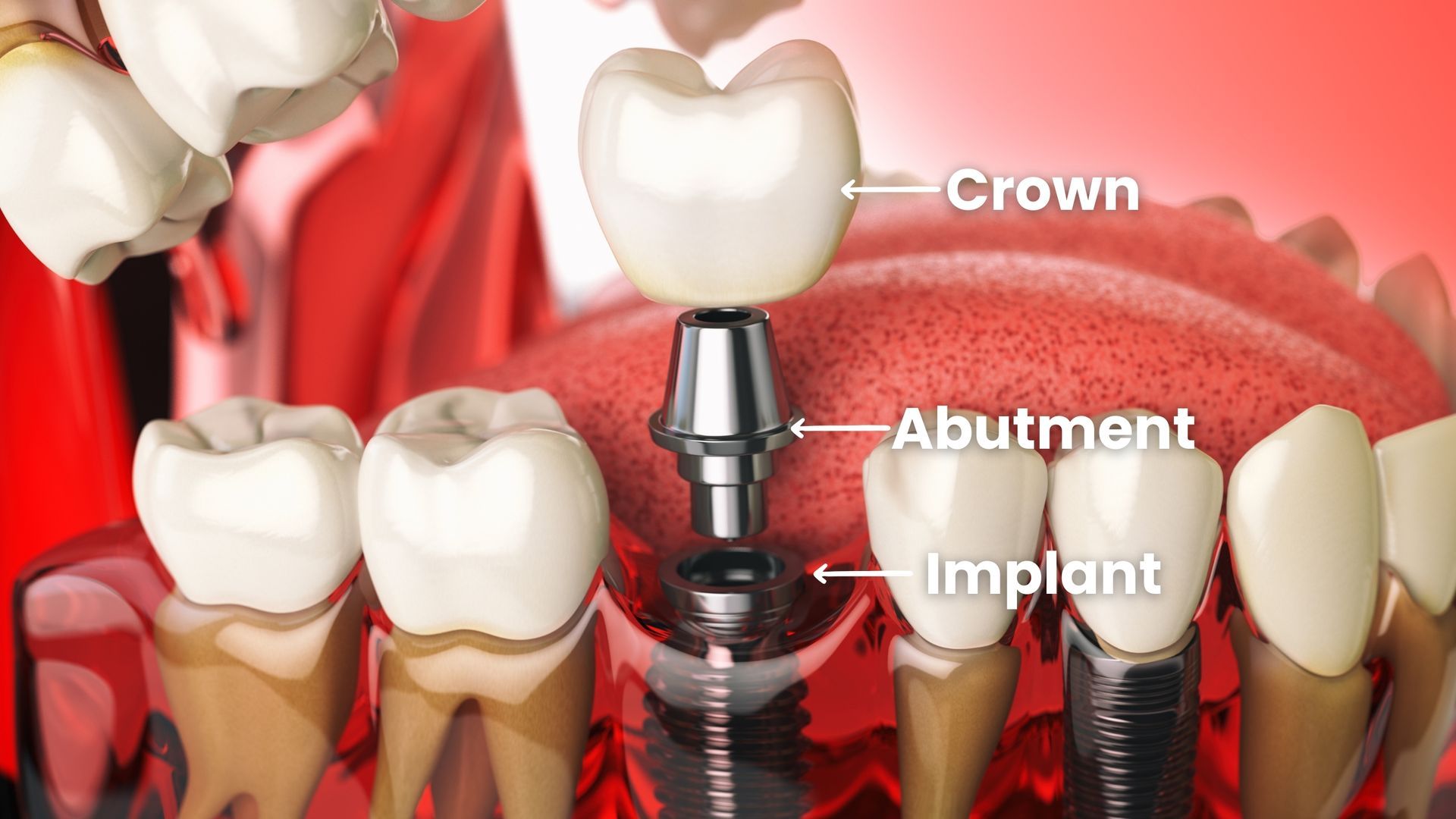 Dental implant diagram: crown, abutment, and implant, with surrounding teeth and gums.