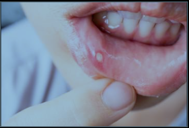 Mouth with a canker sore, lip being touched by a finger.