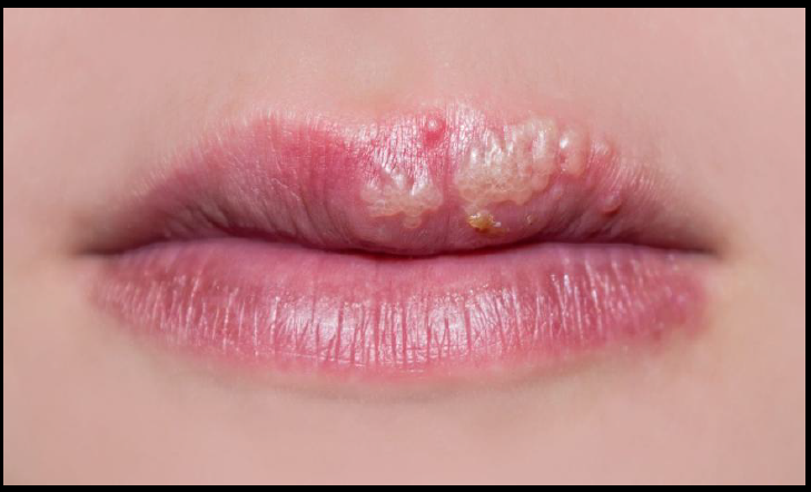 Lips with visible cold sores: clusters of fluid-filled blisters on the lip.