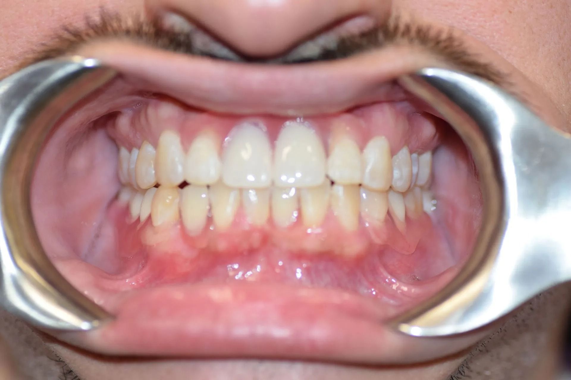 Mouth open, teeth visible. Dental examination with cheek retractor, showing teeth and gums, some redness.