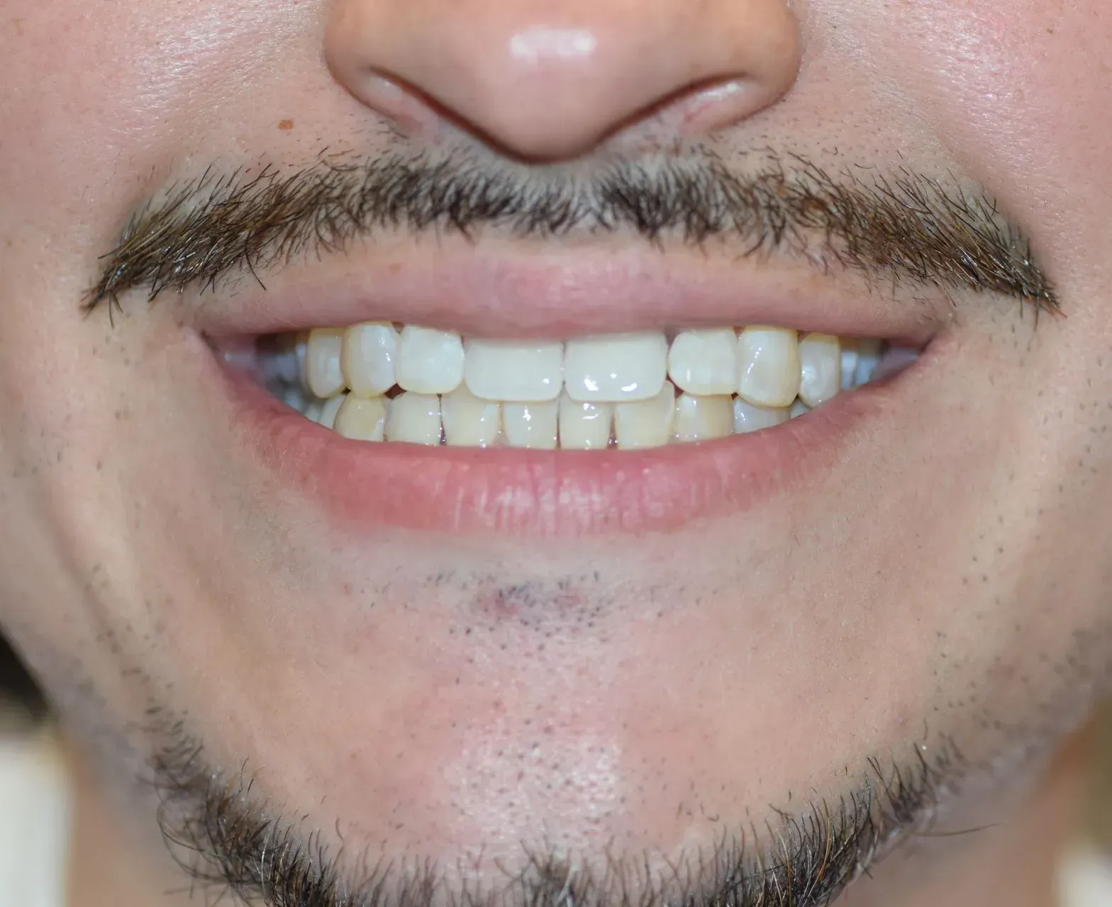 Close-up of a person's smiling mouth. The teeth are visible, and the person has a mustache and goatee.