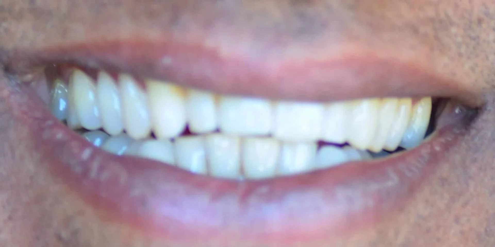 Close-up of a smiling mouth with bright white teeth, pink lips, and a blurred background.