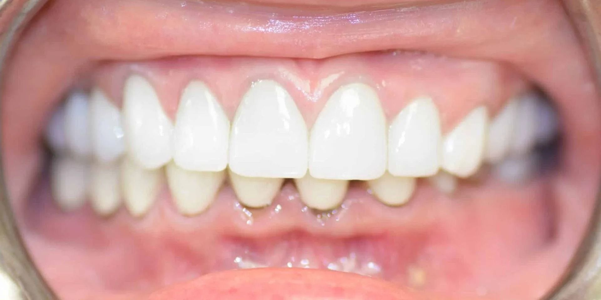 Close-up view of teeth showing the upper and lower arches, with the upper teeth appearing whiter and the lower teeth yellowish.