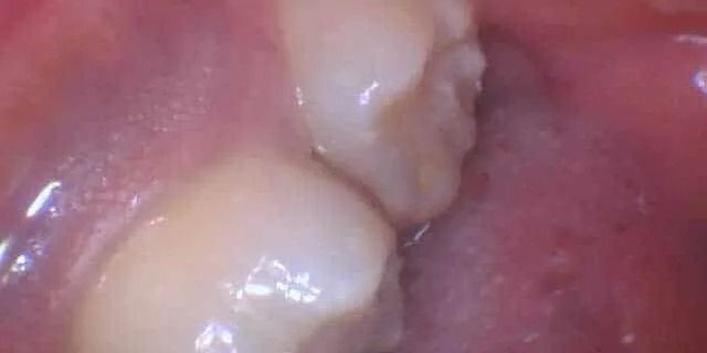 Close-up of two teeth in a mouth, with visible gums.