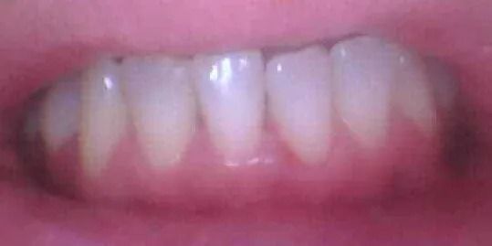 Close-up of human teeth, pale yellow at the base, with pink gums.