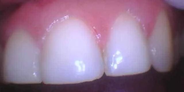 Close-up of human teeth, white with pink gums.