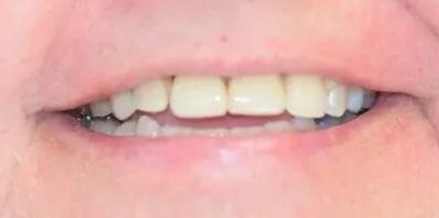 Close-up of a person's teeth, showing a smile with visible upper and lower teeth, and pink gums.