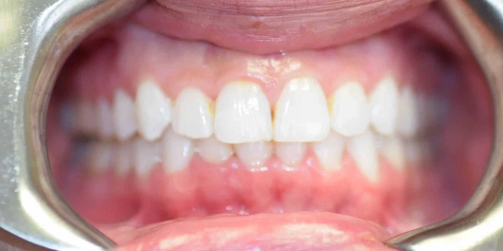 Close-up of a person's teeth, open mouth with a dental retractor. White teeth, pink gums, clear view.