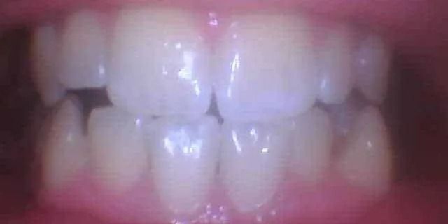 Close-up view of a person's teeth, showing the upper and lower rows, white with a slight gap.