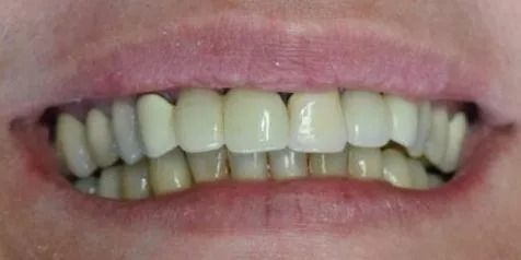 Close-up of a person's mouth with a smile, showing teeth. The upper teeth are bright, while the lower ones are stained.