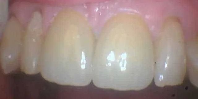 Close-up view of a person's upper front teeth, appearing yellowish-white with the surrounding pink gums visible.