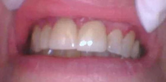 Close-up of a person's teeth. The teeth are yellowed, and the gums are pink.