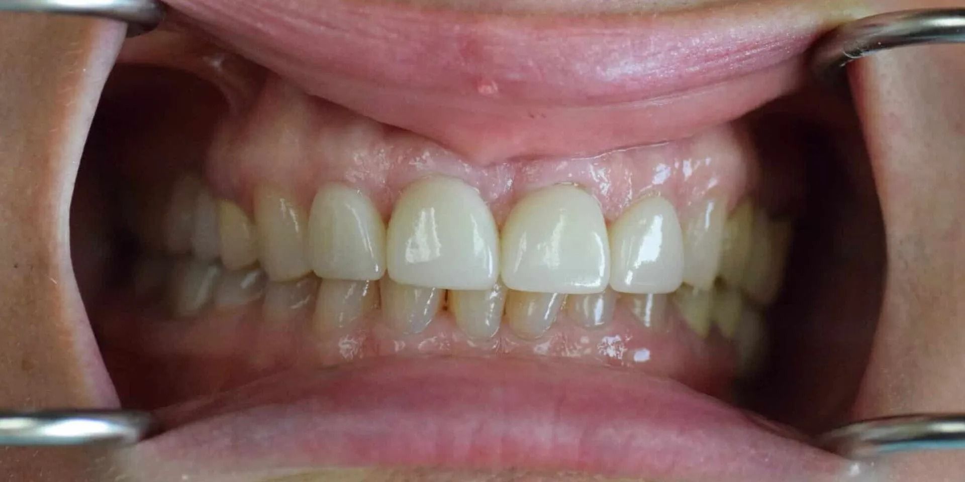 Close-up of a person's teeth being examined. The mouth is open, revealing white teeth, and the cheeks are held open by metal retractors.