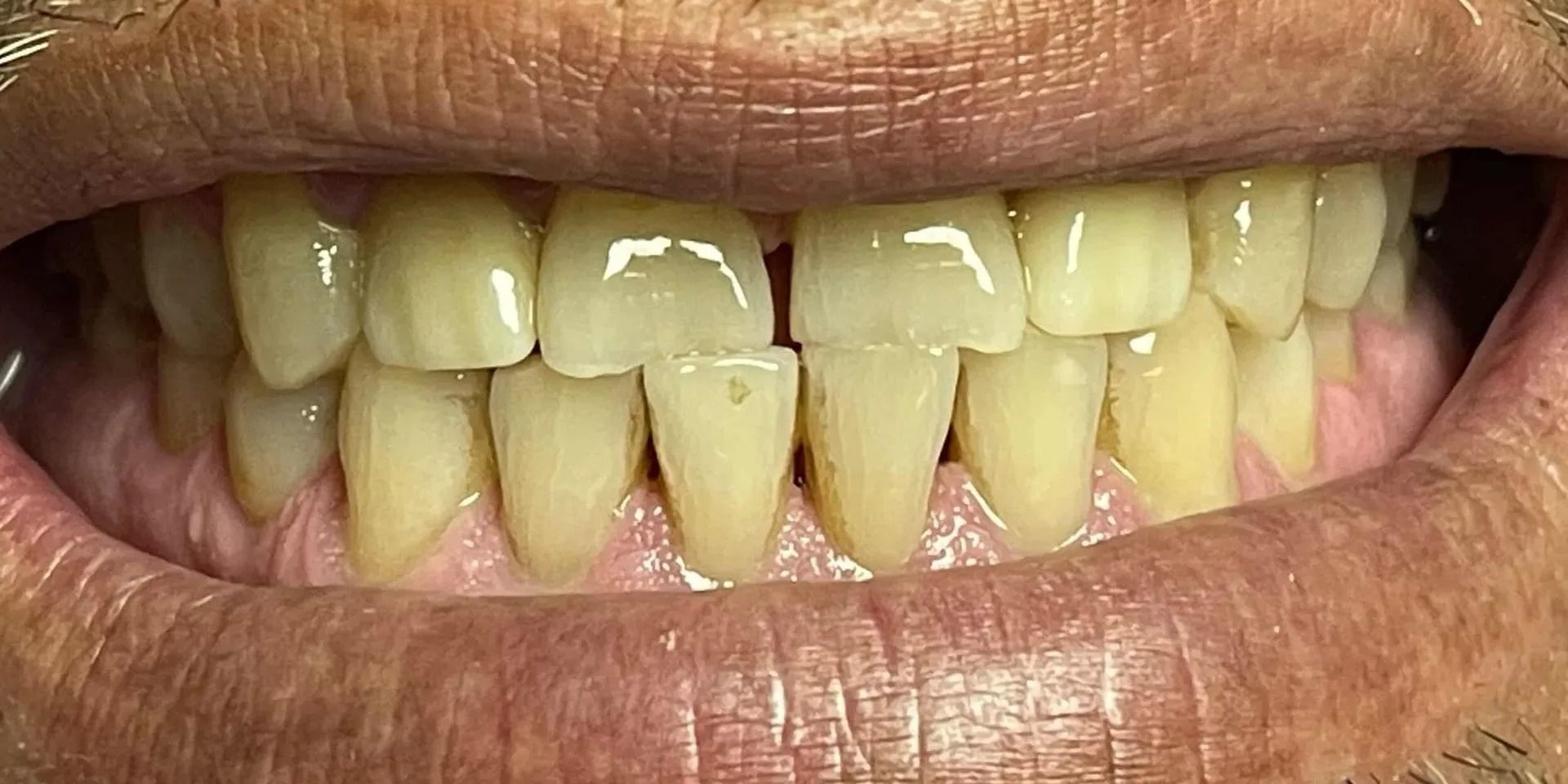 Close-up of teeth. Yellowed teeth with a small gap in the front are visible. Lips and skin surround the teeth.