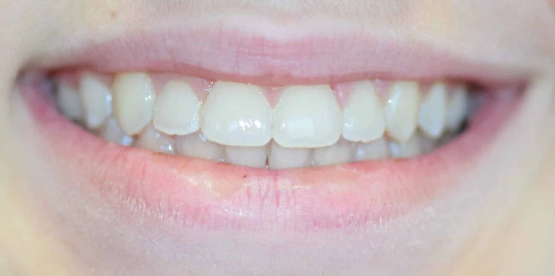 Close-up of a person's smiling mouth showing a set of white, healthy teeth.