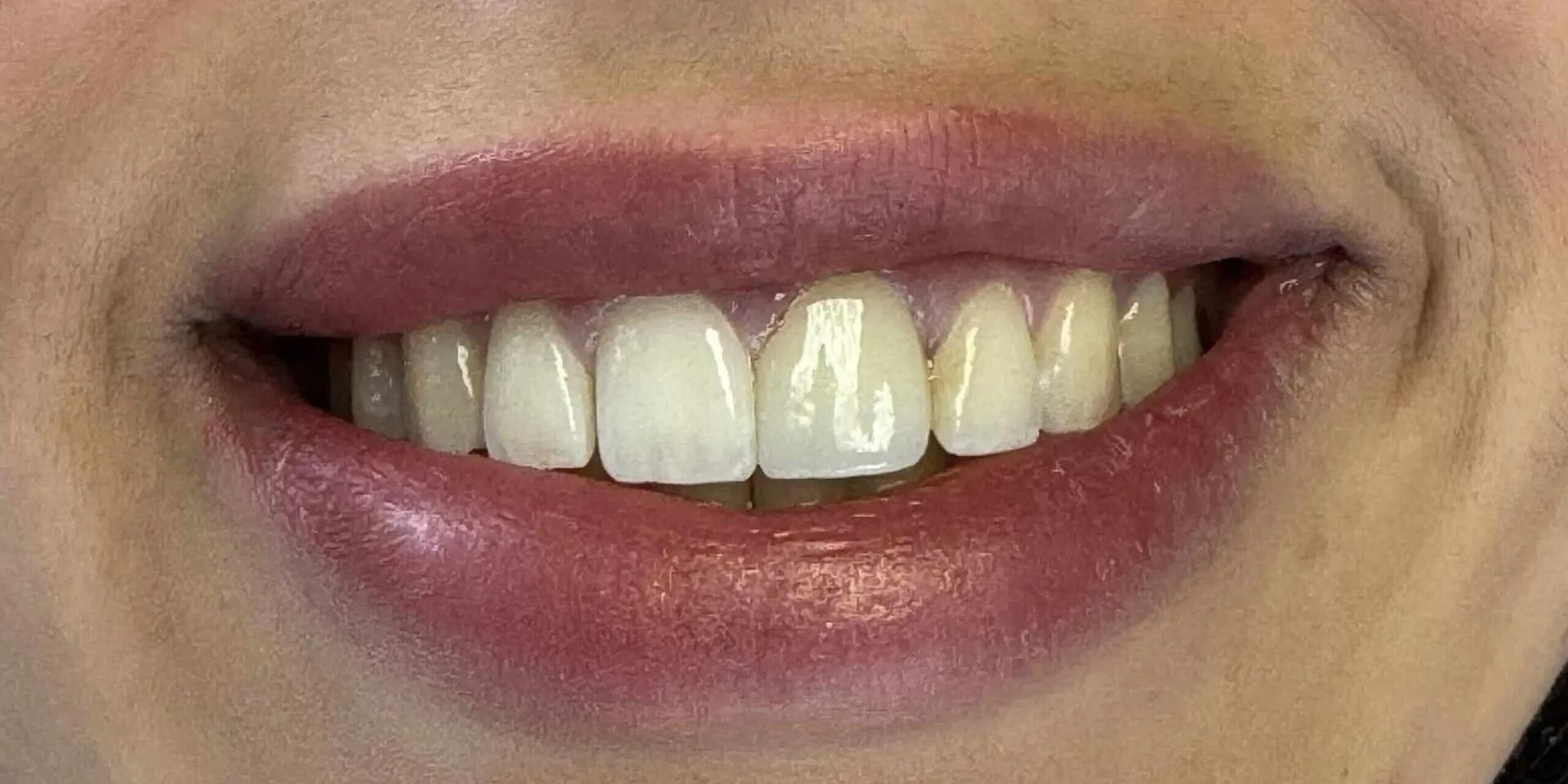 Close-up of a person's smiling mouth showing teeth and pinkish-red lips.