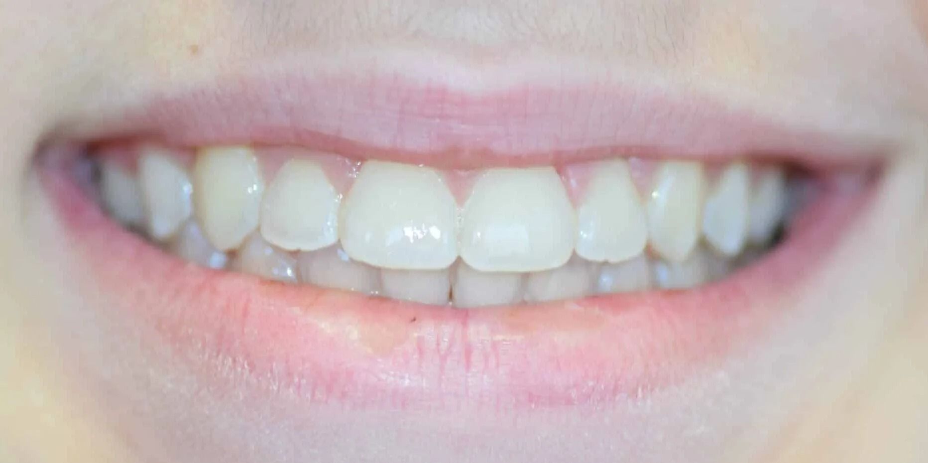 Close-up of a person's smiling mouth, revealing bright white teeth and pink lips.