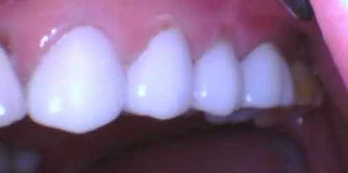 Close-up of human teeth, mostly white with a few yellowed, visible in a mouth.