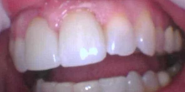 Close-up of a person's upper teeth. The teeth are white with a bit of pink gum showing. The mouth is open.