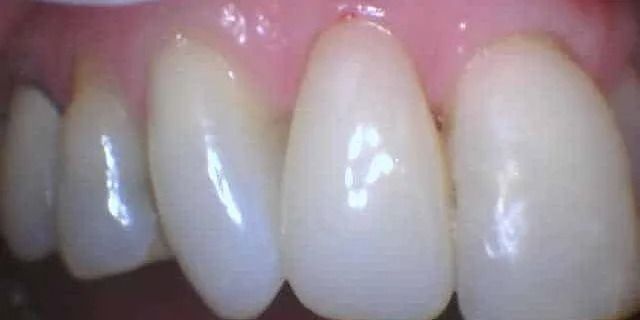 Close-up of teeth, displaying white, smooth surfaces with pink gums visible above.