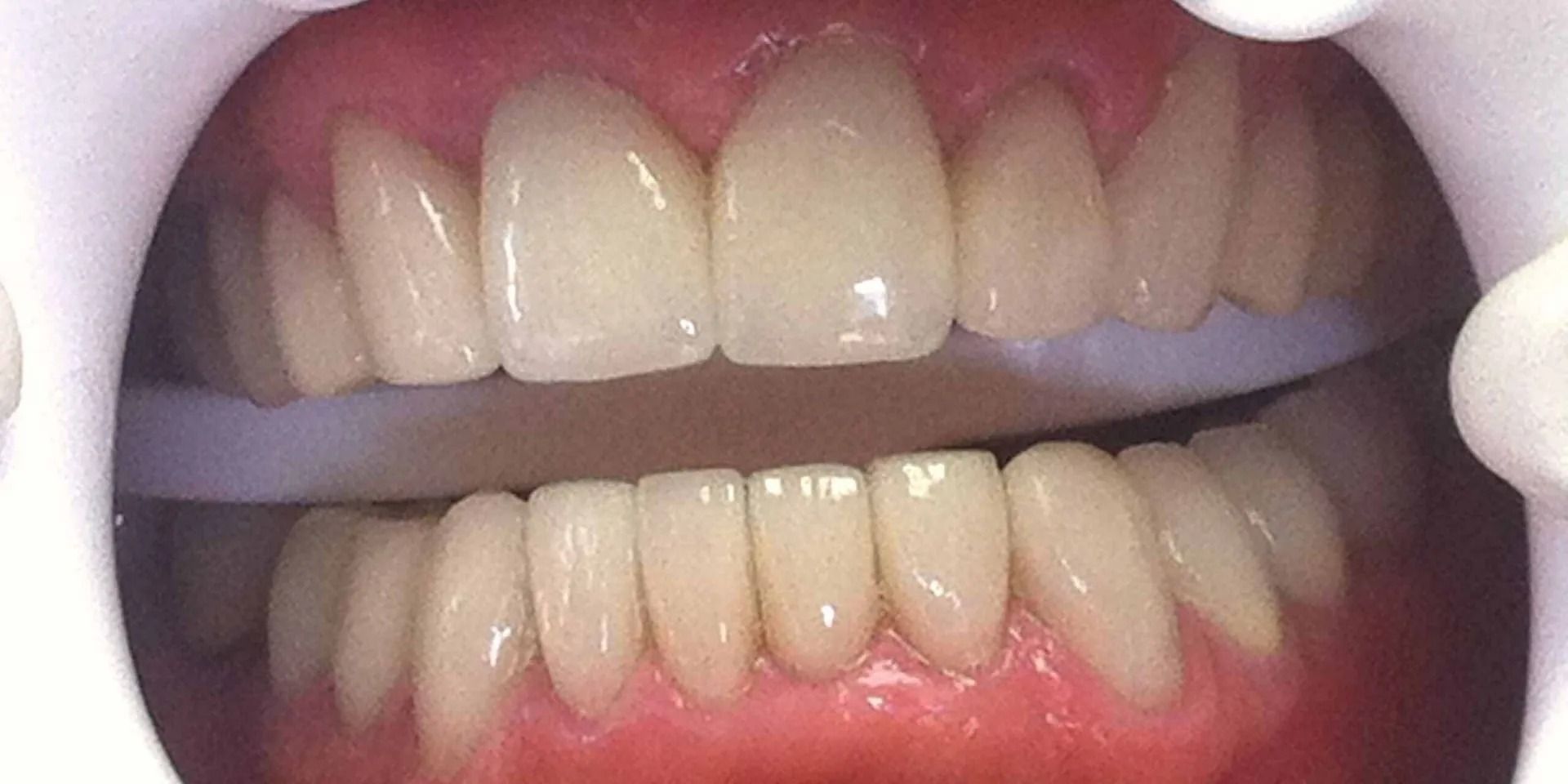 Close-up of a person's teeth. Dental equipment is used to keep the mouth open, showing healthy teeth and gums.