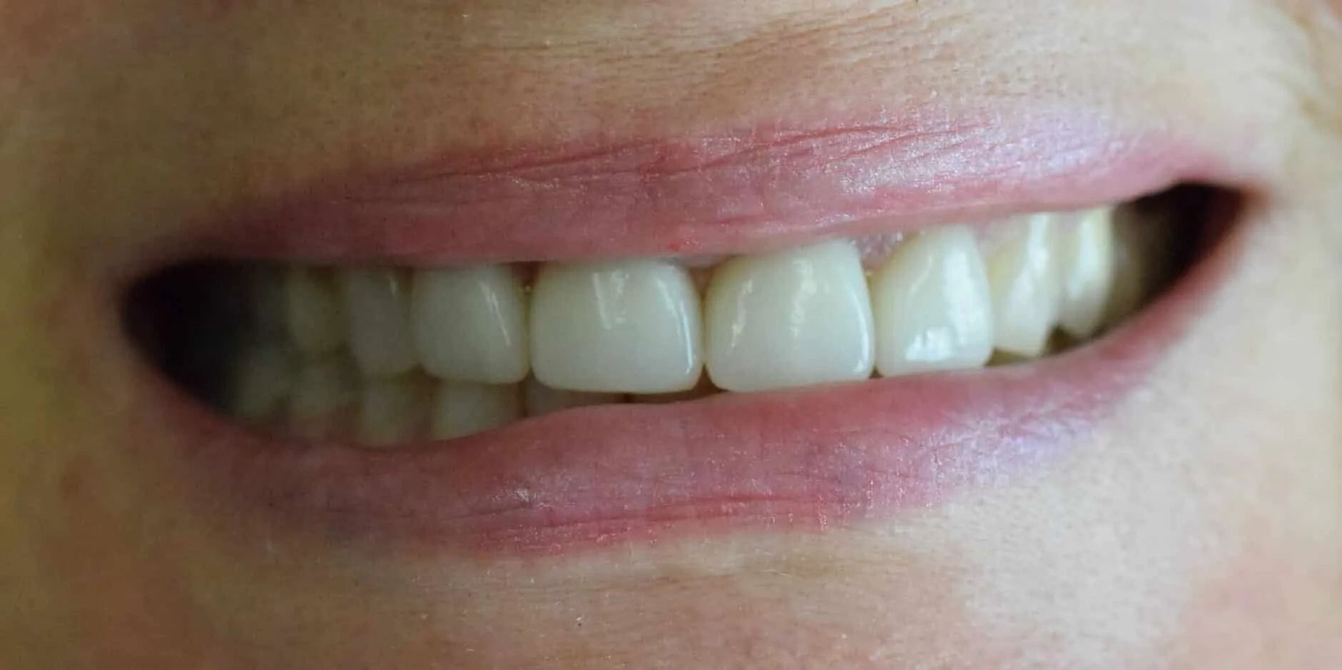 Close-up of a person's mouth with a bright smile, showing straight, white teeth and pink lips.