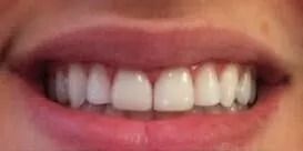 Close-up of a person's smiling mouth. The teeth are white, and the lips are pink.