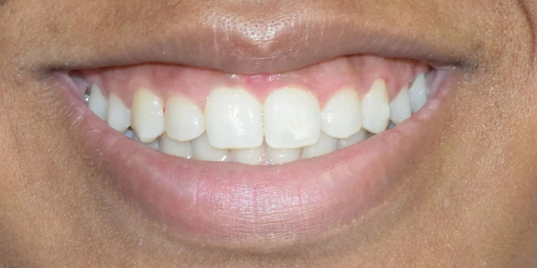 Close-up of a person's smiling mouth, showing bright white teeth and pink gums.