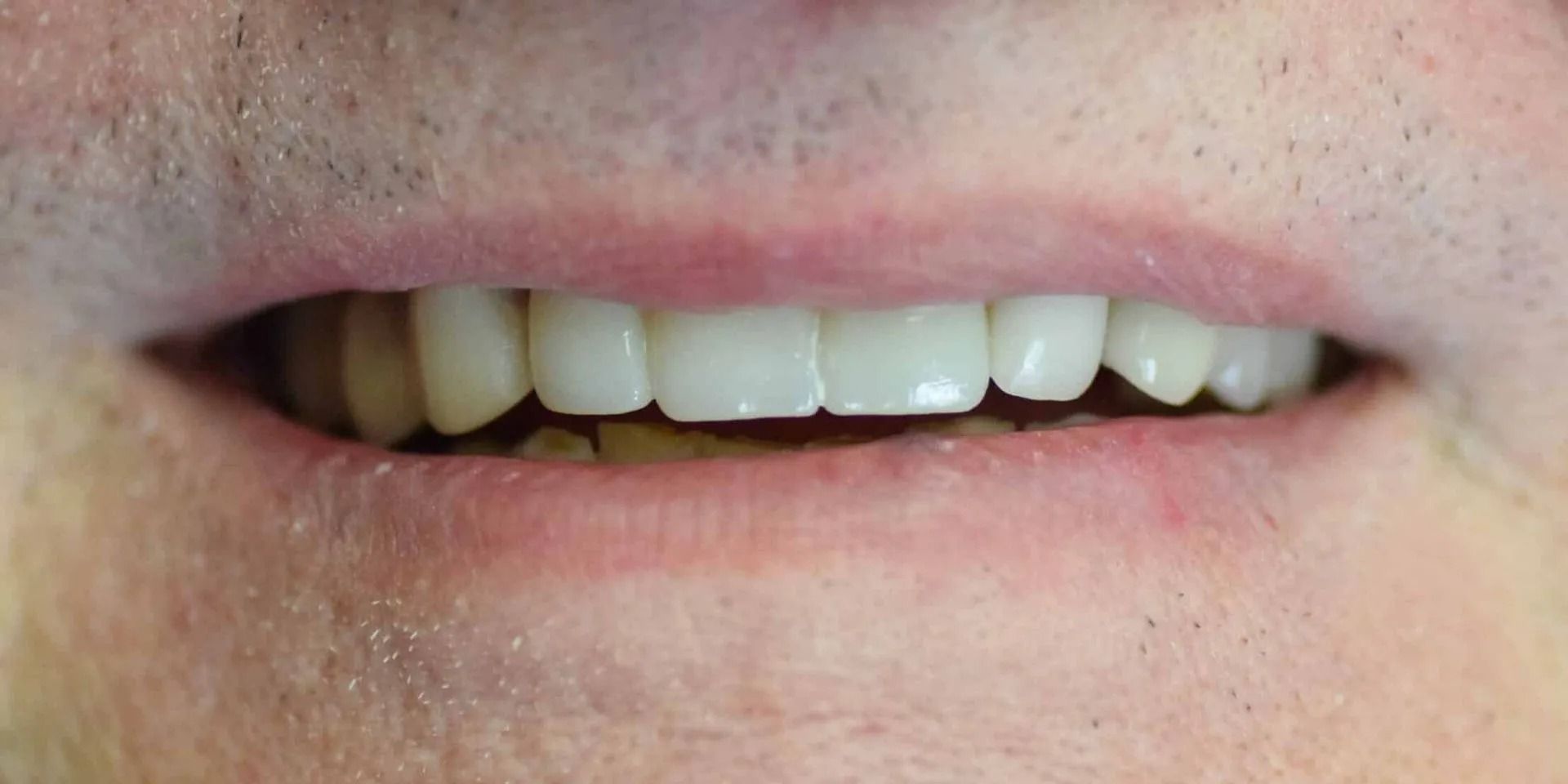 Close-up of a person's mouth, showing upper and lower teeth, with a slight smile. The upper teeth are white.