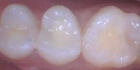 Close-up of three teeth, creamy white with visible ridges, showing healthy enamel.