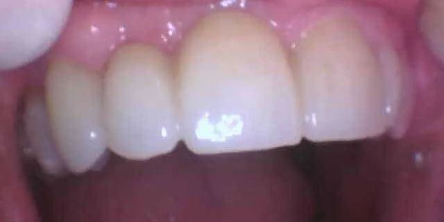 Close-up of a person's teeth. The teeth are white with a glossy finish. Pink gum tissue is visible.