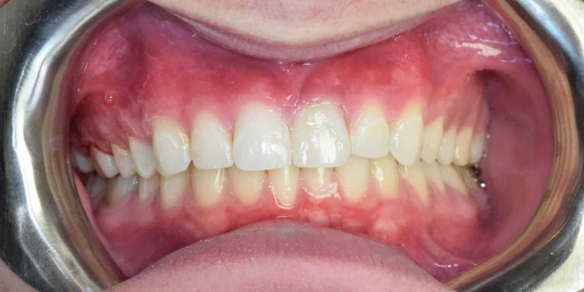 Teeth and gums in a dental examination, showing healthy white teeth and pink gums.
