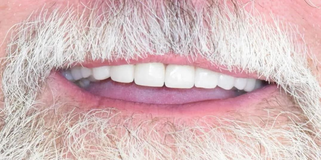 Mouth with teeth held open by dental tools. Teeth appear discolored, with gaps and yellowing. The gums are pink.