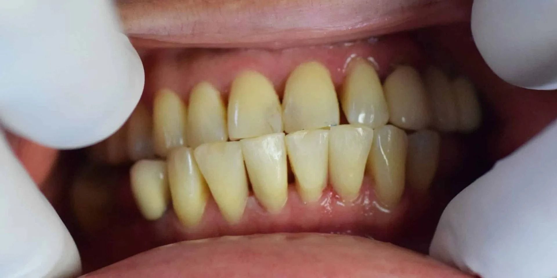 Close-up of teeth being examined by gloved hands, showing yellowed teeth and pink gums.