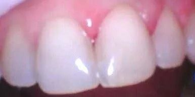 Close-up of front teeth with white enamel and pink gums.