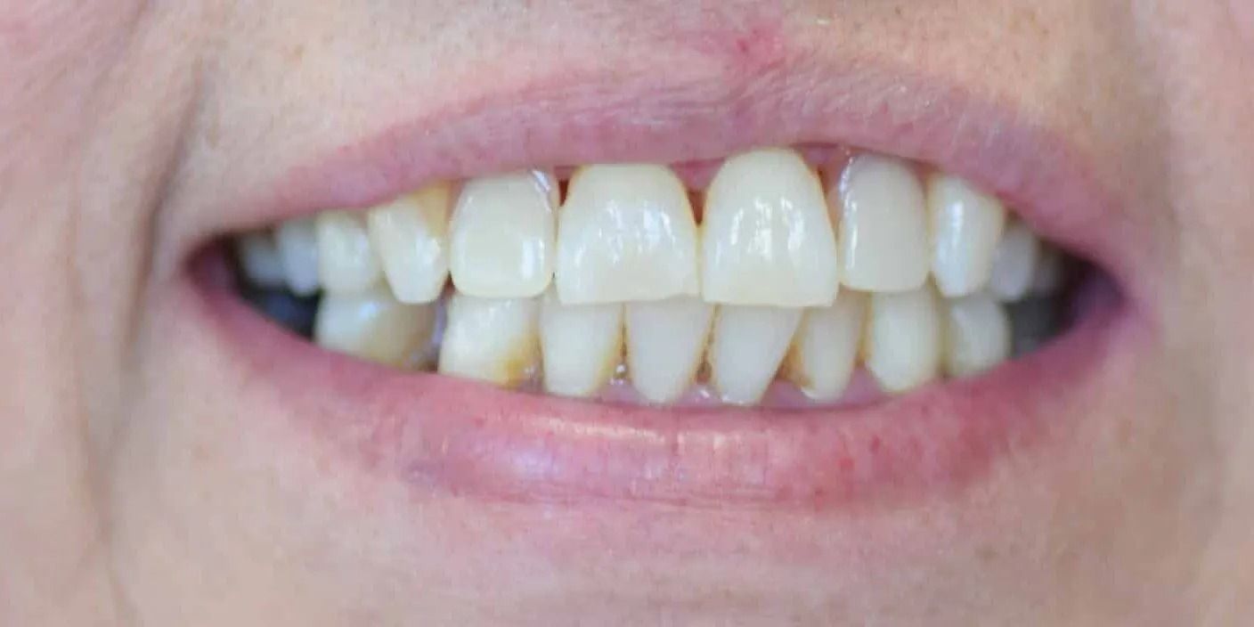 Close-up of a person's teeth, showing slight discoloration, with the lips slightly parted in a smile.