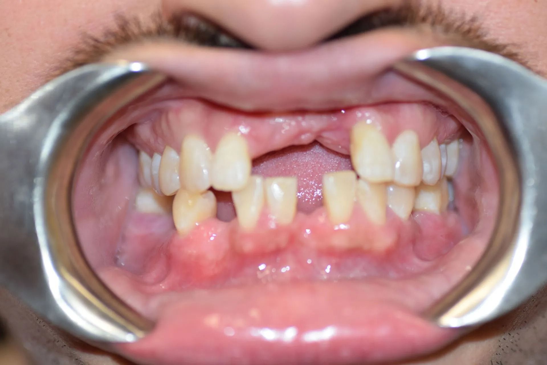 Mouth with missing and damaged teeth, held open with dental tools.