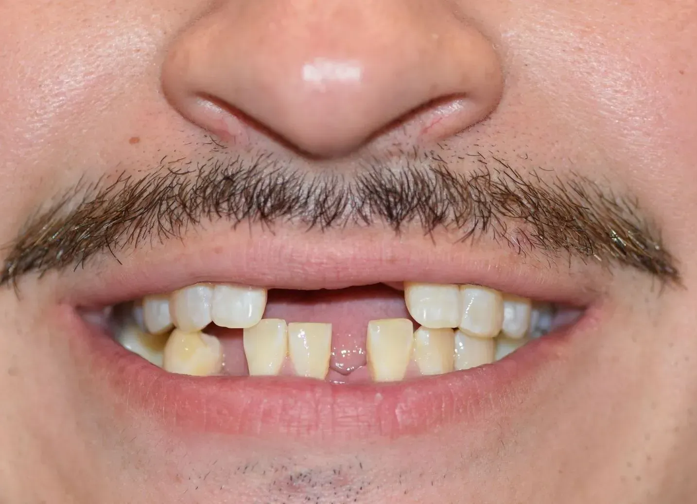 Close-up of a person's mouth with a gap between the two front teeth and a mustache.