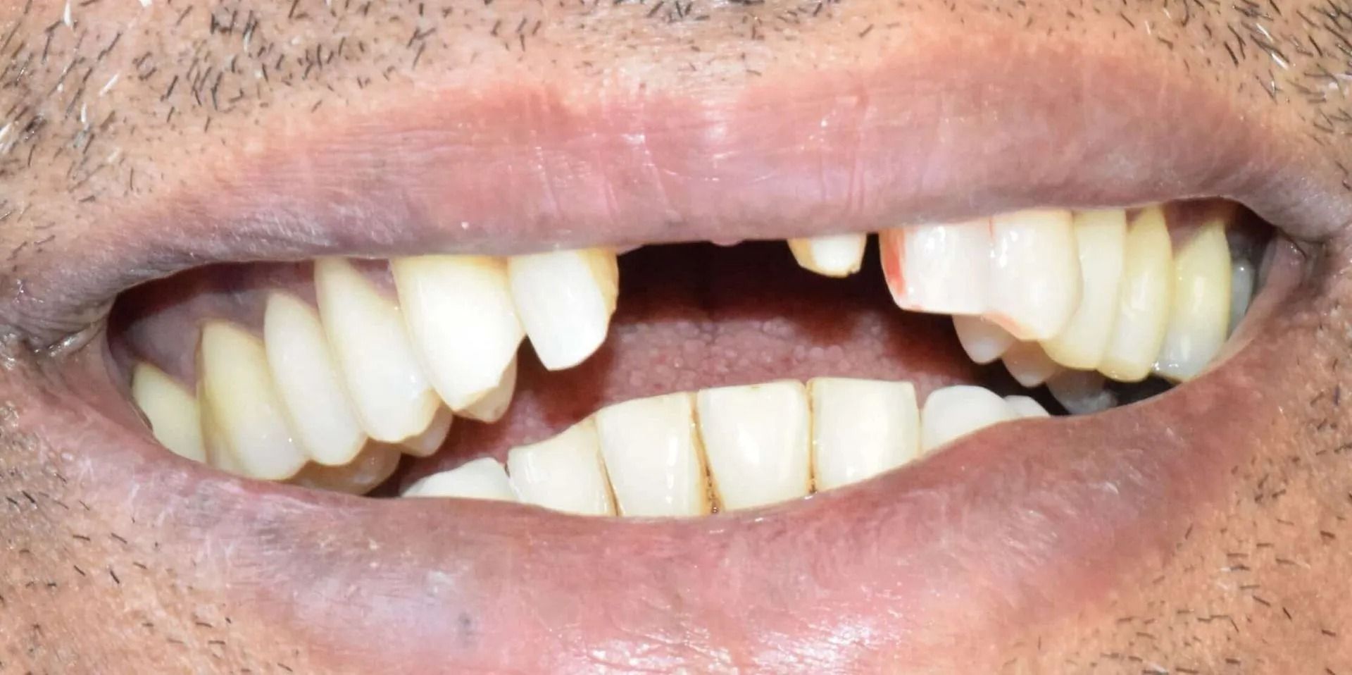 Close-up of a person's mouth with missing and damaged teeth. The lips are open, revealing the teeth and gums.