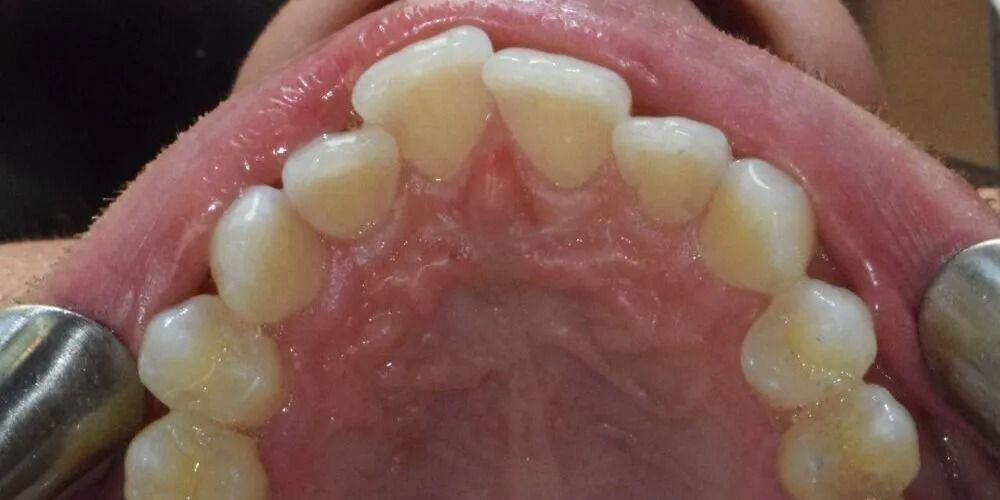 Close-up of the roof of a mouth with teeth visible. The teeth are white with yellowing and the gums are pink.