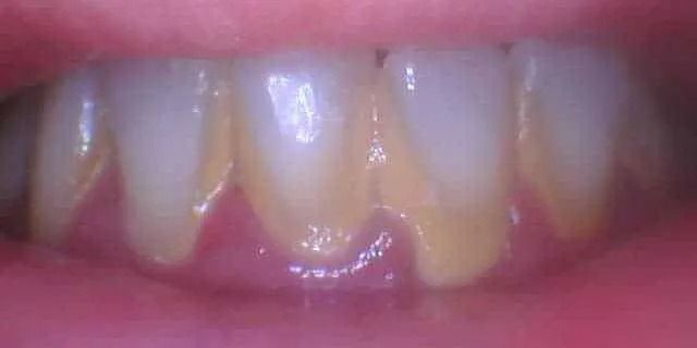 Close-up view of teeth with visible yellowing at the gumline.