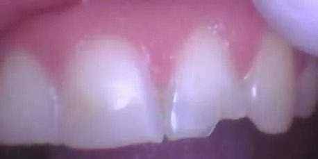 Close-up of teeth and gums; teeth appear slightly discolored with a small chip on one. Pink gums visible.