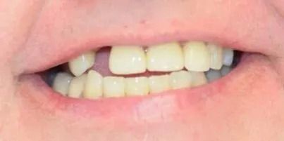 Close-up of a person's teeth. One front tooth is missing.