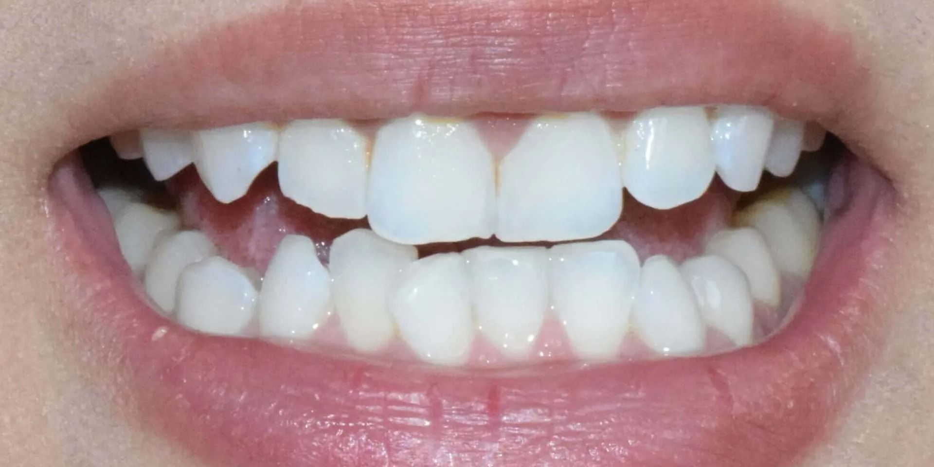 Close-up of a person's teeth showing slightly misaligned upper and lower teeth, with a pink mouth.