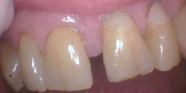 Close-up view of teeth in a mouth. The teeth are yellowish with a slight gap between two front teeth. Pink gums are visible.