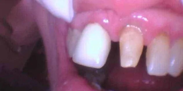 Close-up of teeth: one tooth is bright white, next tooth is a yellow tint, with pink gums.