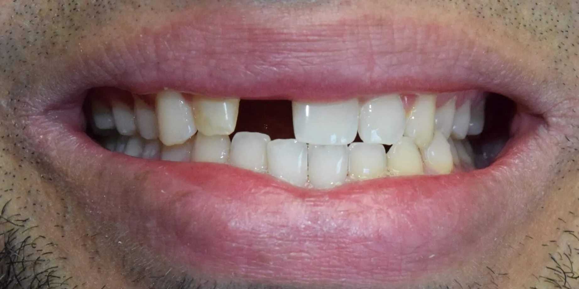Close-up of a person's mouth with a missing front tooth and slightly crooked teeth.