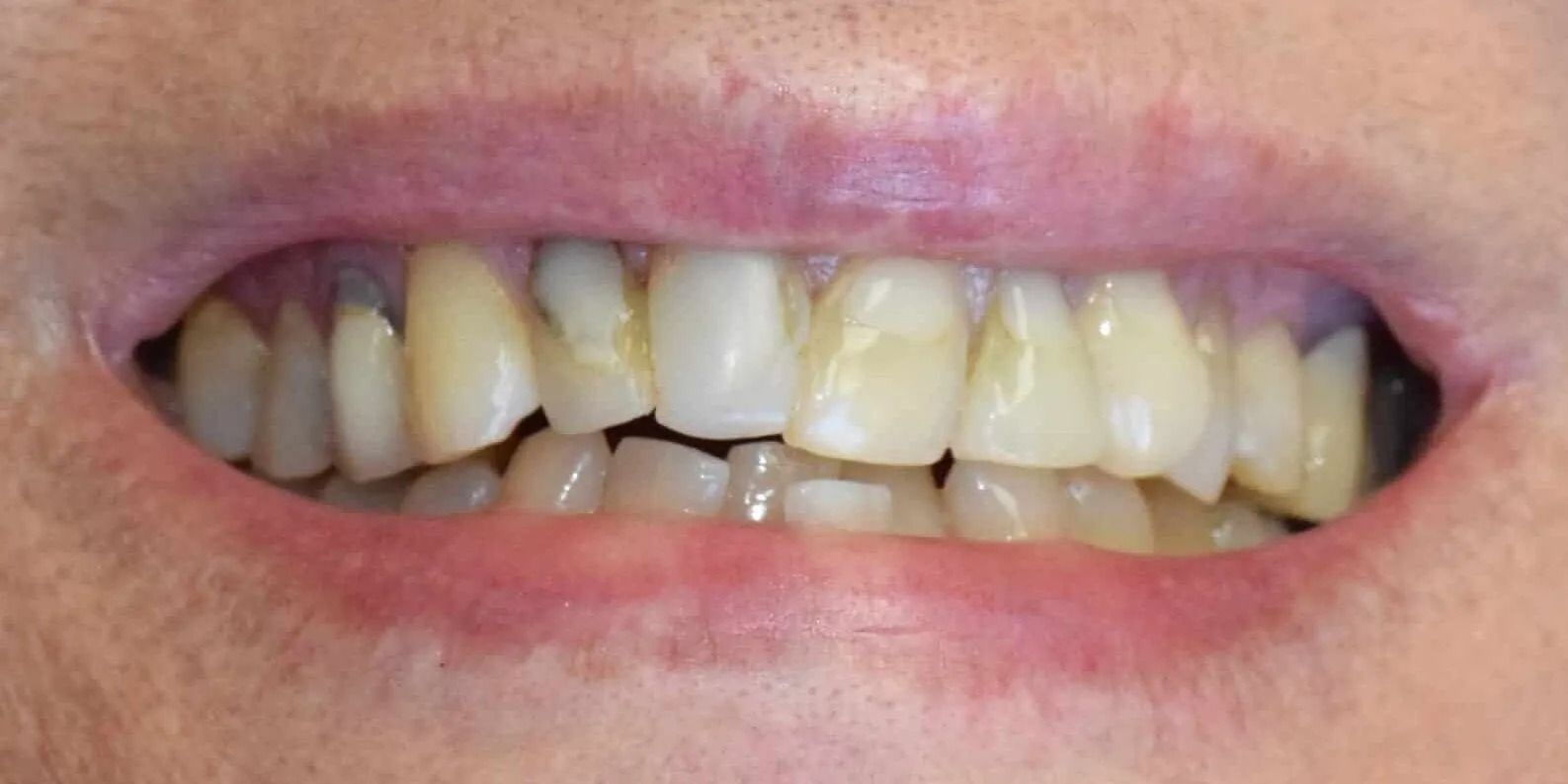 Close-up of a person's teeth. The teeth are discolored and slightly misaligned. Lips are pink.